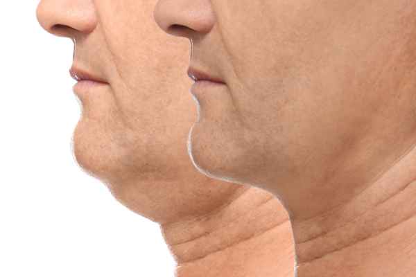 HIFU - Breakthrough in Anti - ageing 2 hifu results Kingswinford