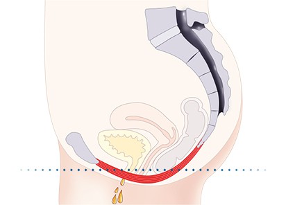 Pelvic-Floor Muscle Repair 5 Pelvic floor muscles Kingswinford