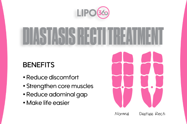 Revolutionising Muscle Repair: The Power of LIPO360 Body Sculpt Post-Injury 5 diastasis recti treatment Kingswinford