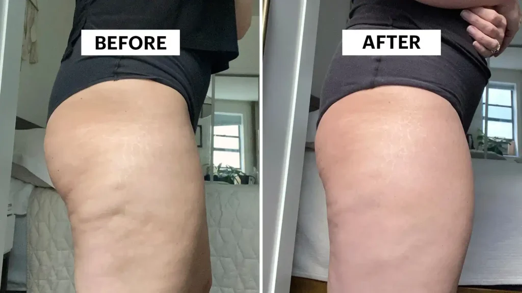 Sculpting Your Bum: Can Toning Exercises Really Reduce Cellulite? 1 Do Toning Exercise Kingswinford Really Tackle Cellulite?