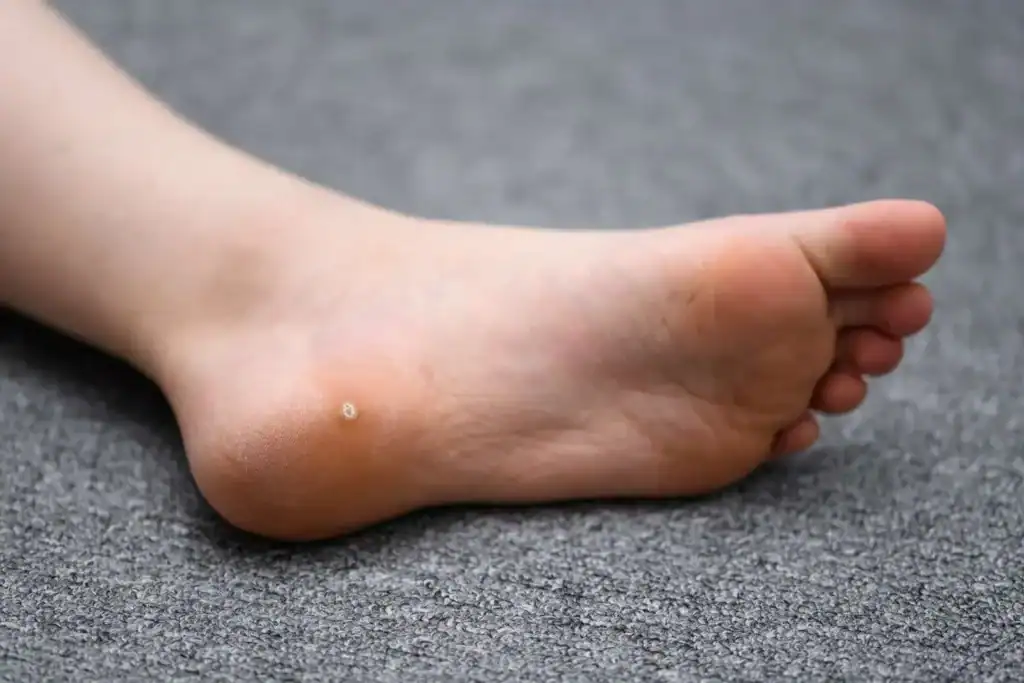 Cryotherapy For Warts And Also Verrucas 2 Image of verruca on the bottom of the foot that able to be treated with Cryotherapy Kingswinford