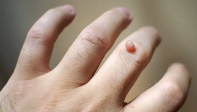 Image of blemish that Cryotherapy Kingswinford can remove with Lipo 360.