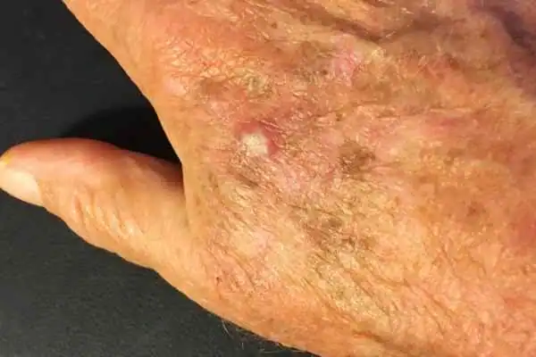 Image of Actinic keratoses Kingswinford on a person hand