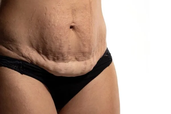 The Science of Skin Tightening 1 The science behind skin tightening Kingswinford picture of a woman's sagging skin on the stomach